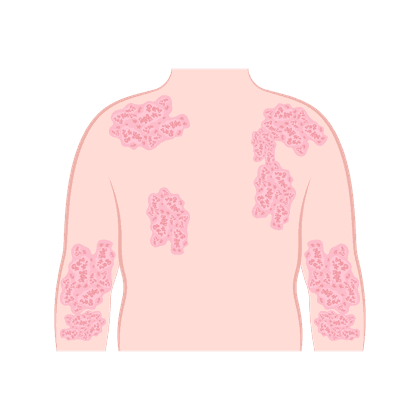 Atopic dermatitis and eczema