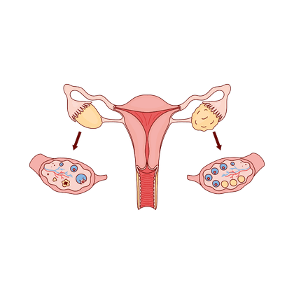 Polycystic ovary syndrome (PCOS)