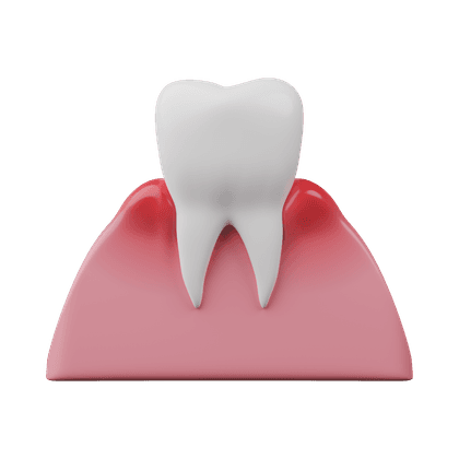 Gingivitis (inflammation of the gums)